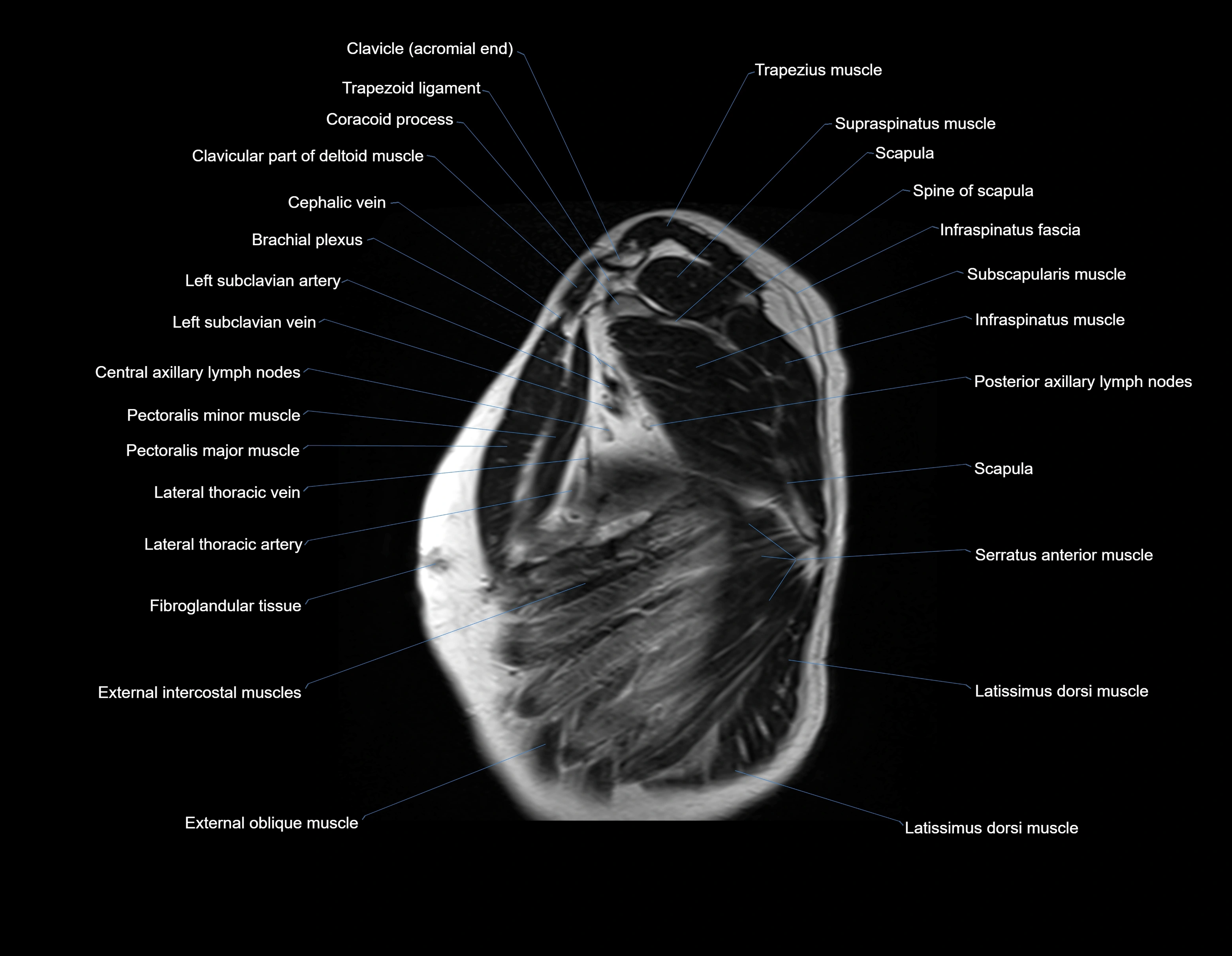 MRI chest (thorax) sagittal labelled cross sectional anatomy 3T radiology image-img-00001-00034.webp